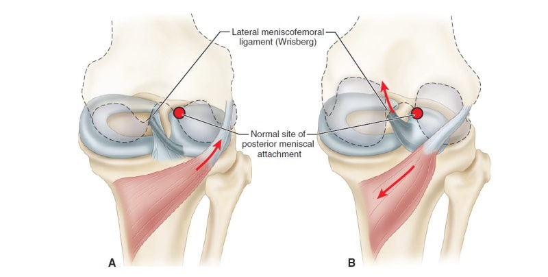원판형 연골판 (discoid meniscus) : 네이버 블로그