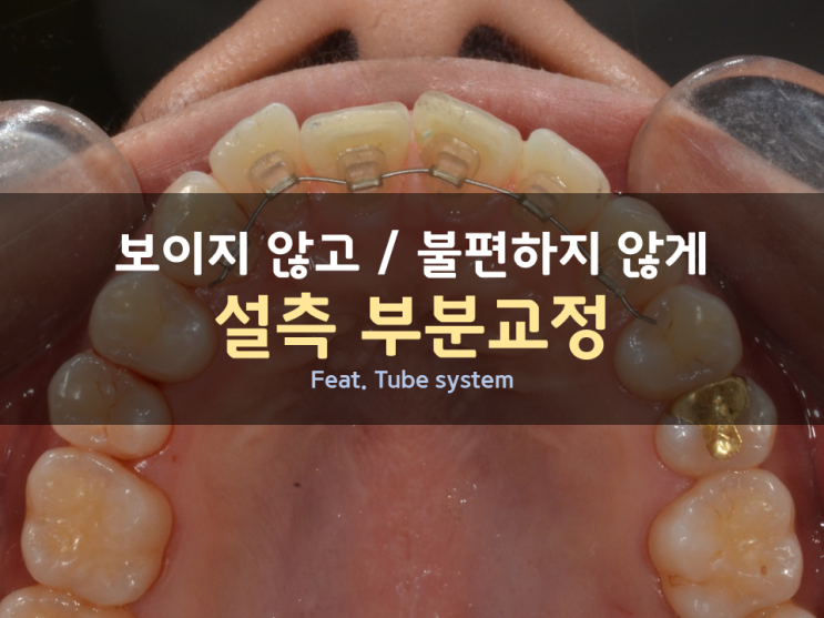 부분교정만으로 앞니를 가지런히 / 설측교정으로 간단하게 해결하기 부분교정만으로 앞니를 가지런히 / 설측교정으로 간단하게 해결하기