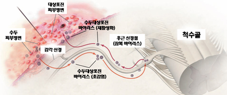  대상포진 초기증상 원인 및 예방법 등