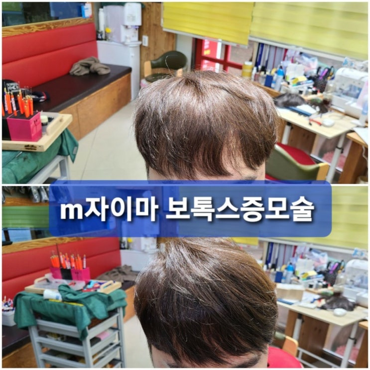  m자 이마 탈모도 #보톡스증모술 이죠~^^(30대 남성편)