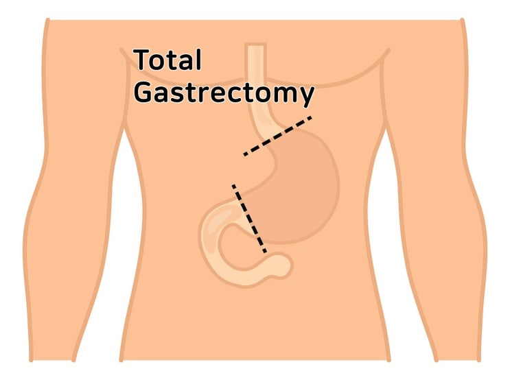 gastrectomy RSG RTG 위수술 간호