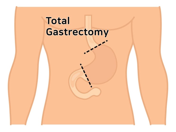  gastrectomy RSG RTG 위수술 간호