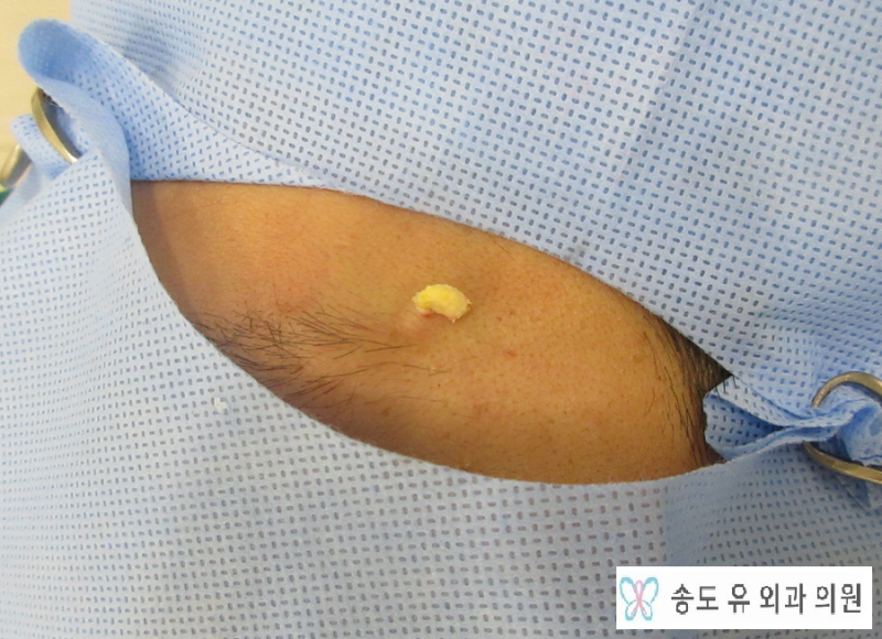 인천- 이마에 발생한 혹 - 이마 지방종,이마 피지낭종,이마 표피낭종 핀홀법 수술에 대한 글입니다 - [인천 송도 유 외과 ...