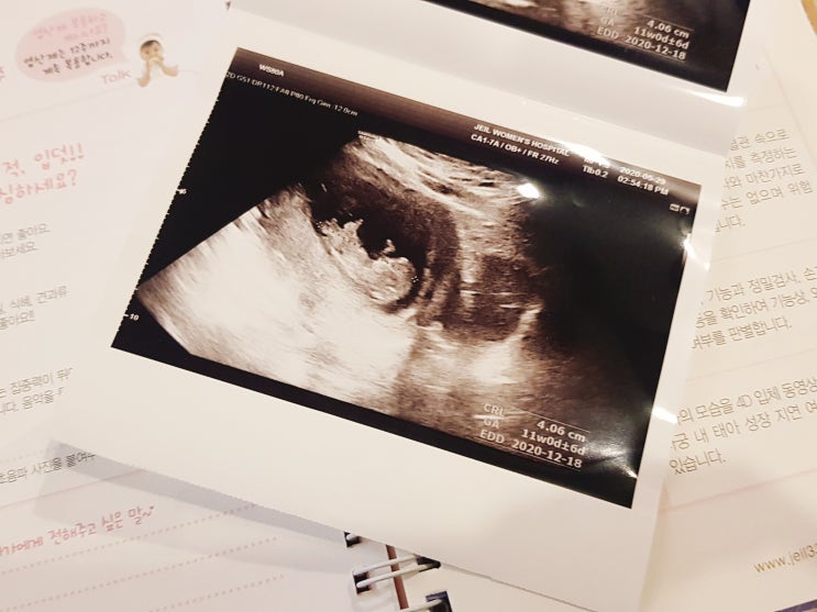 임신일기⑤ 3개월[임신 9주차~11주차 증상] 초음파, 하이베베 성공 
