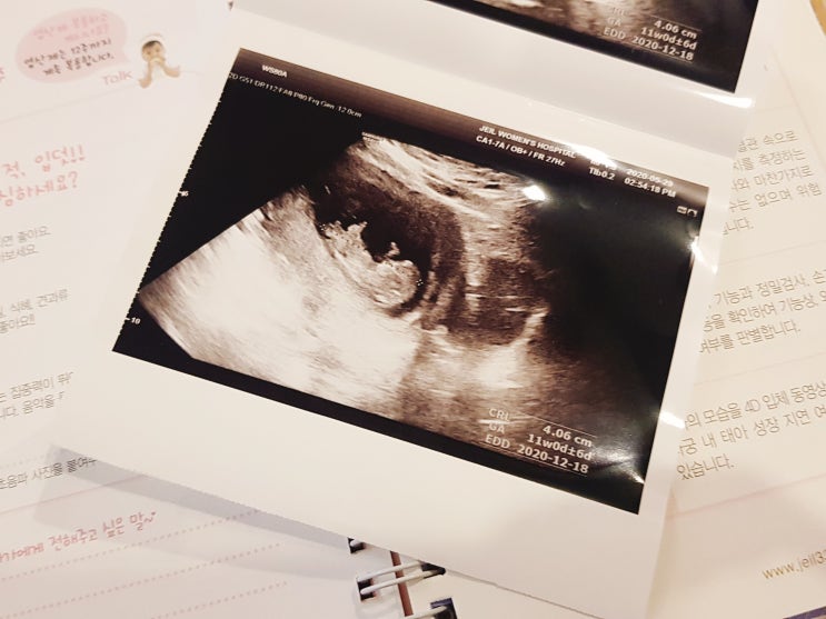  임신일기⑤ 3개월[임신 9주차~11주차 증상] 초음파, 하이베베 성공 