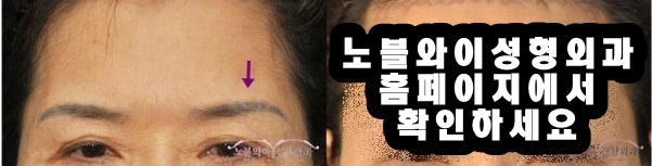  이마주름수술 나이를 되돌리자 !