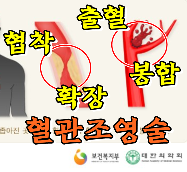  혈관조영술(뇌, 심장) 검사·치료 및 부작용