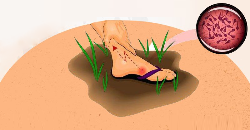 파상풍 주사 기간, 가격, 초기증상을 알려드립니다. 꼭 정확히 알고 대처하세요. : 네이버 블로그