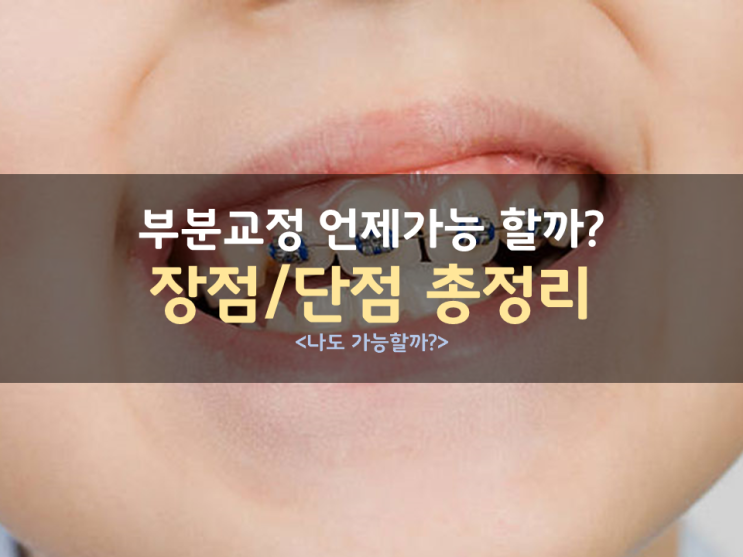 어떤 경우에 부분교정이 가능할까? / 부분교정 장점, 단점 -총정리 (미사교정치과) 어떤 경우에 부분교정이 가능할까? / 부분교정 장점, 단점 -총정리 (미사교정치과)