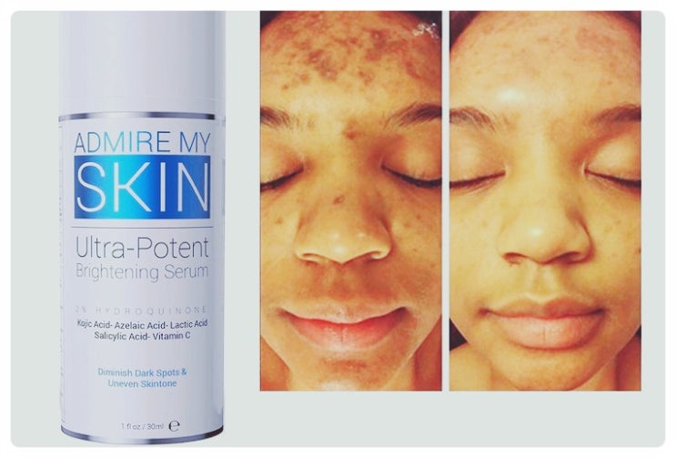  오랜만! Admire My Skin Ultra Potent Brightening Serum Treatment Fade Cream 기미 잡티 검버섯이 사라지는 10년 젊어지는 얼굴, 1개, 이예요!