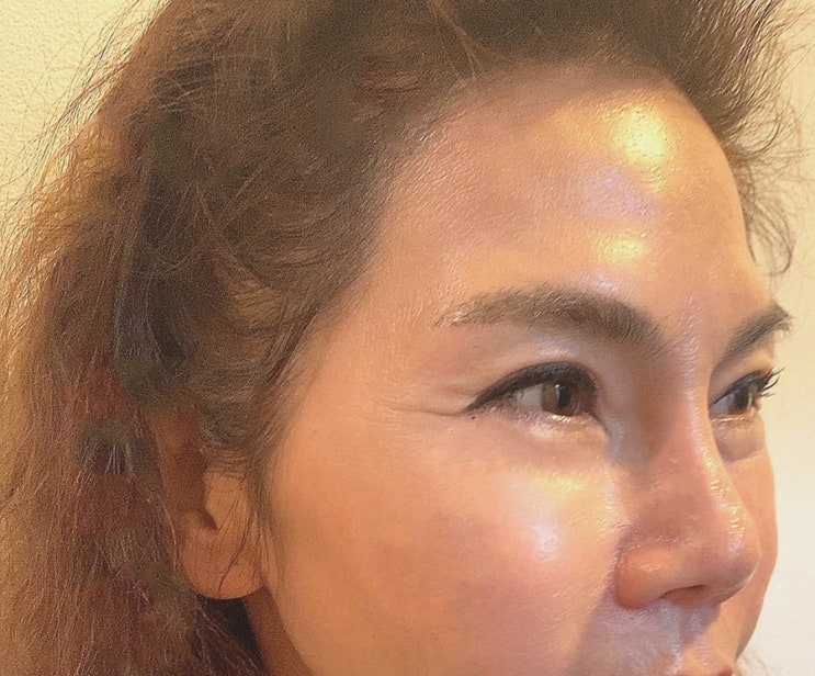  10년젊어졋다고 좋아하는 엄마의 스컬트라 논현동피부과 다녀온 후기! (팔자주름스컬트라)