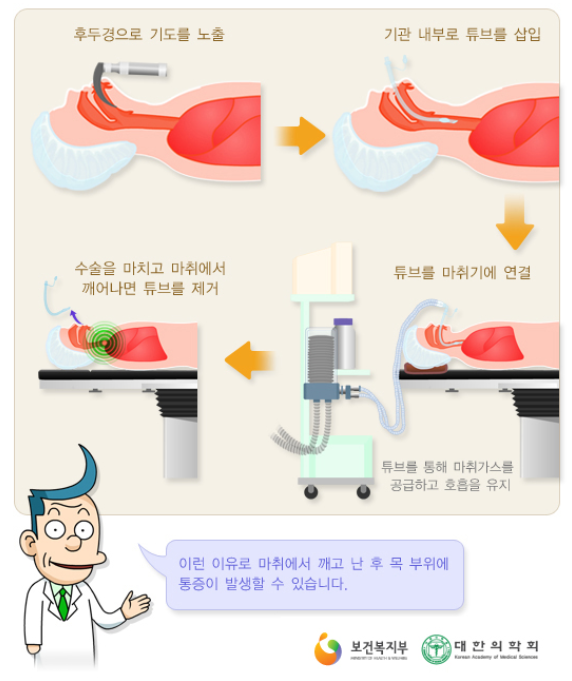 윤곽수술&gt; 제발 제발 전신마취로 좀 수술하세요. (전신마취와 수면마취의 차이)