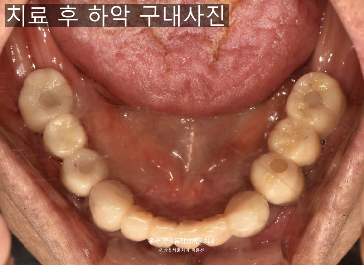  원주에서 임플란트 잘하는 곳, 원주 무실동 삼성서울치과에서 고령환자 임플란트 하기