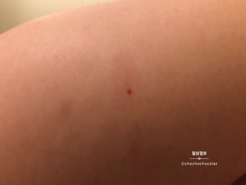 무는 파리, 샌드플라이 흡혈곤충 주의!벌레 물린 자국,대처법 : 네이버 블로그 무는 파리, 샌드플라이 흡혈곤충 주의!벌레 물린 자국,대처법 : 네이버 블로그