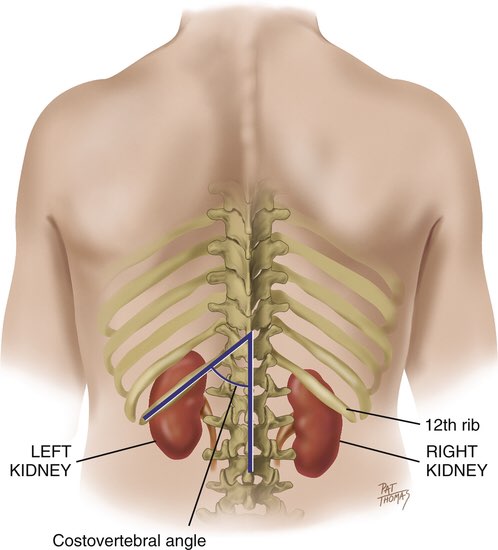  [PK생활] CVA Tenderness : 급성신우신염, 요로결석 때 검사할 수 있는 신체검사. ( APN, renal stone, etc)