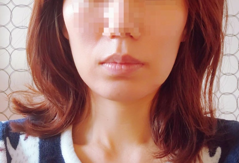 돌출입교정일기(7) +361일 : 땅콩형 얼굴, 팔자주름 출몰 / 연세고운미소치과 : 네이버 블로그 돌출입교정일기(7) +361일 : 땅콩형 얼굴, 팔자주름 출몰 / 연세고운미소치과 : 네이버 블로그