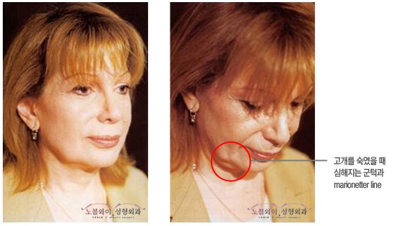  안면거상 왜 하는지 알겠네요