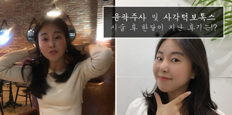  양재역, 강남 "NS윤곽주사 + 턱보톡스 전후 후기" 한 달 지난 지금 궁금하쥬~?