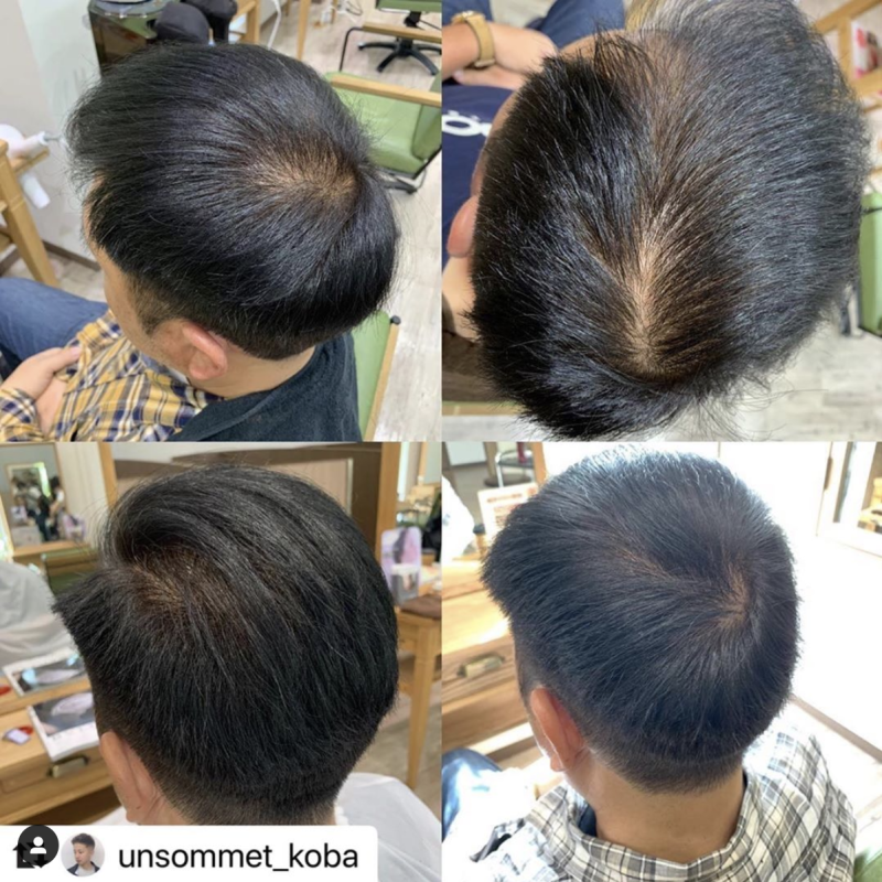 탈모치료후기 나에게 맞는 7