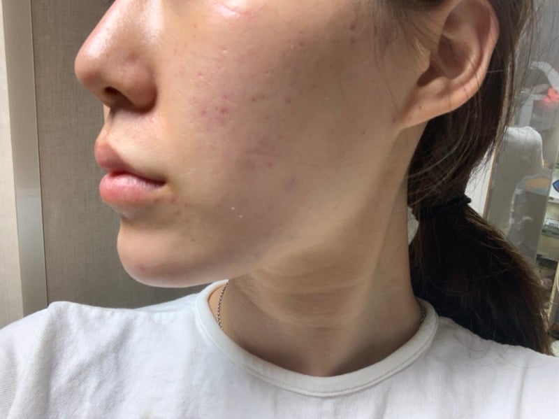 문정역피부과에서 스킨보톡스 12
