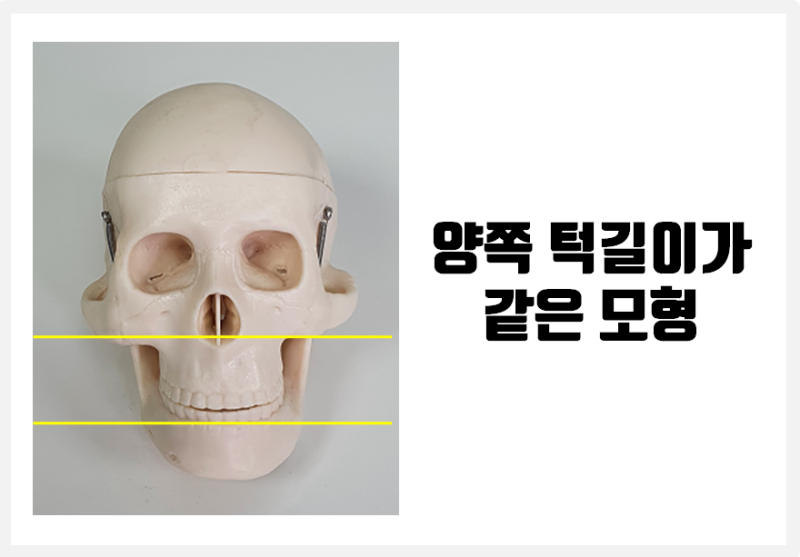 턱길이, 뼈길이가 다른 턱비대칭_안면비대칭 X-ray 진단, 그대로 믿어도될까? #안면비대칭교정 #양악수술 : 네이버 블로그