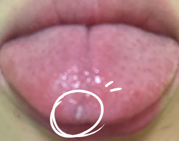  혓바늘 없애는법 오라메칠 좋네욧