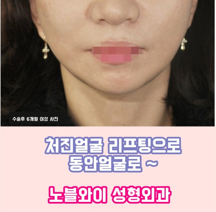  처진얼굴리프팅 필요하다면 지금 !