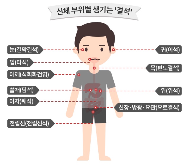  눈에도 결석이!!결막결석