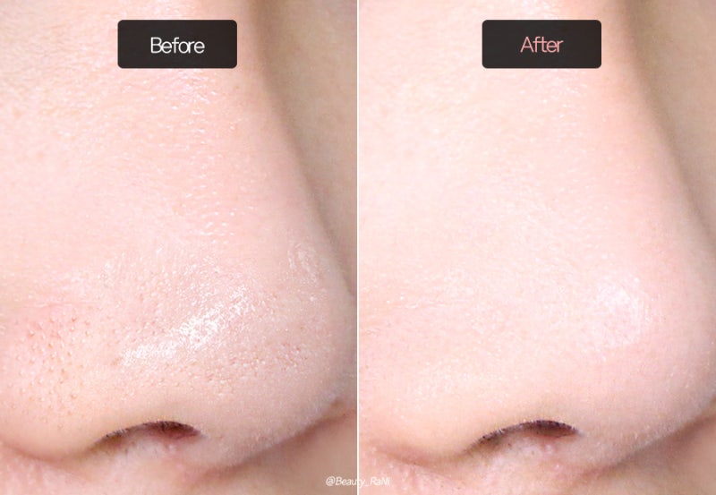 일산피부과 9월 1회 체험 아우라 화이트닝 스킨케어 받아온 솔직한 후기