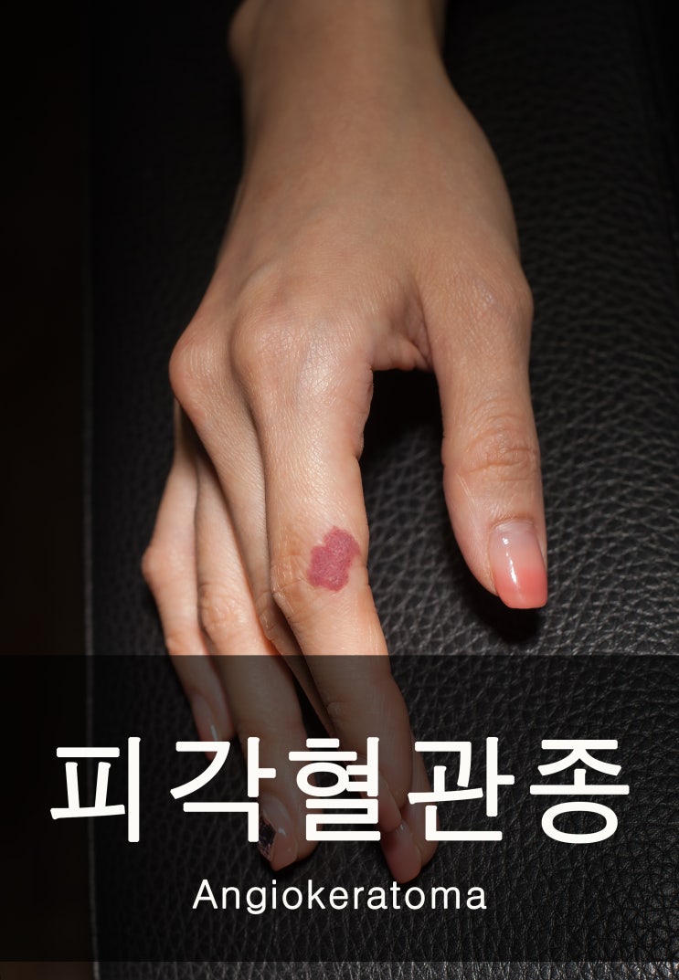  피부에 빨간점 '손가락에 발생한 피각 혈관종 제거'