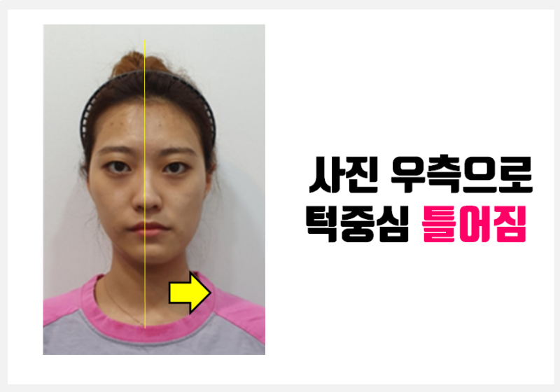 턱길이, 뼈길이가 다른 턱비대칭_안면비대칭 X-ray 진단, 그대로 믿어도될까? #안면비대칭교정 #양악수술 : 네이버 블로그