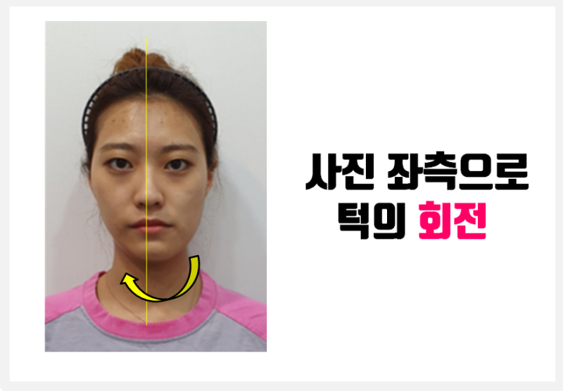 턱길이, 뼈길이가 다른 턱비대칭_안면비대칭 X-ray 진단, 그대로 믿어도될까? #안면비대칭교정 #양악수술 : 네이버 블로그
