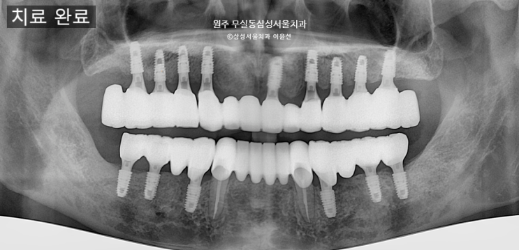  어금니가 없어서 못씹겠어요~ㅠ, 원주 무실동 삼성서울치과에서 임플란트 하기