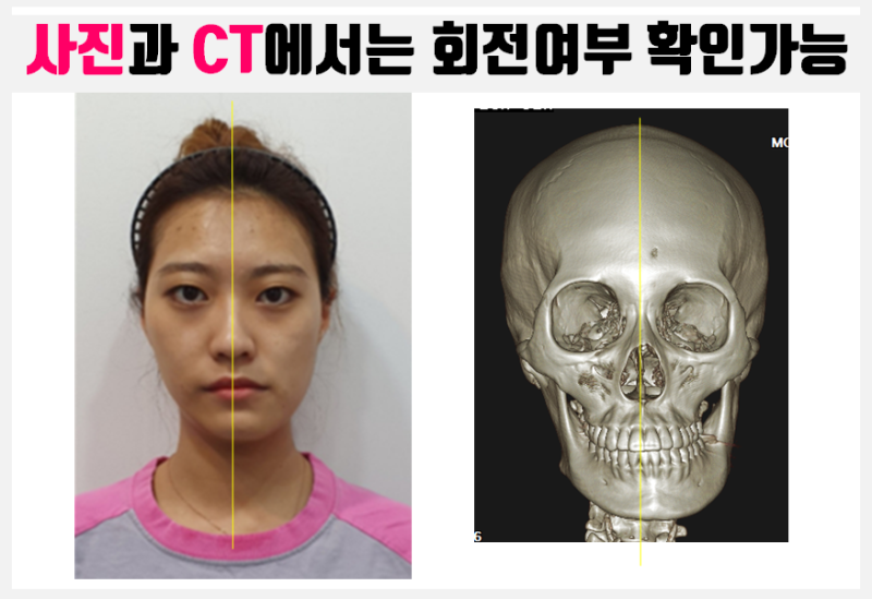 턱길이, 뼈길이가 다른 턱비대칭_안면비대칭 X-ray 진단, 그대로 믿어도될까? #안면비대칭교정 #양악수술 : 네이버 블로그