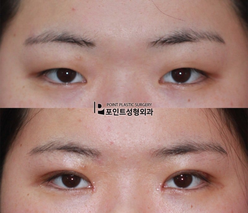まぶたが分厚い場合 部分切開目つき矯正手術の症例写真 네이버 블로그