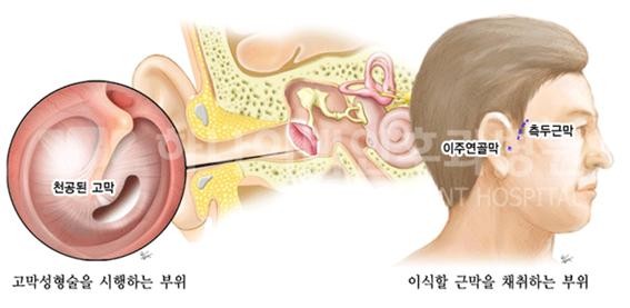 귀에서 진물이 나요 - 성수이비인후과의 중이염치료 : 네이버 블로그