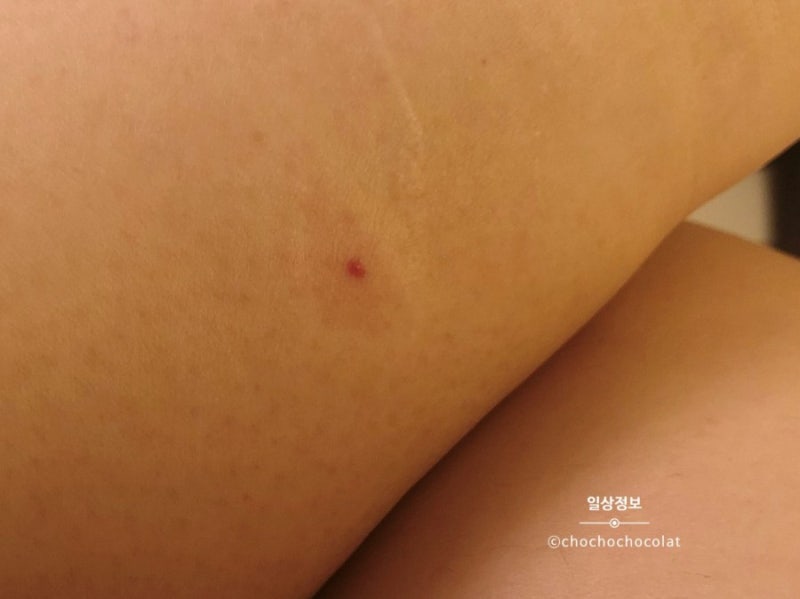 무는 파리, 샌드플라이 흡혈곤충 주의!벌레 물린 자국,대처법 : 네이버 블로그 무는 파리, 샌드플라이 흡혈곤충 주의!벌레 물린 자국,대처법 : 네이버 블로그