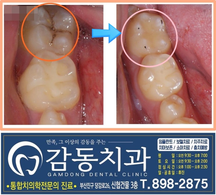  레진치료후주의사항