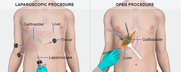 cholecystectomy 담낭절제술 이유 Q&A 수술 후 주의사항 꼼꼼 정리 : 네이버 블로그 Cholecystectomy 담낭절제술 이유 Q&A 수술 후 주의사항 꼼꼼 정리 : 네이버 블로그