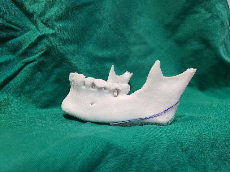 3D프린터 를 이용한 사각턱수술 : 정밀하고 안전한 안면윤곽수술
