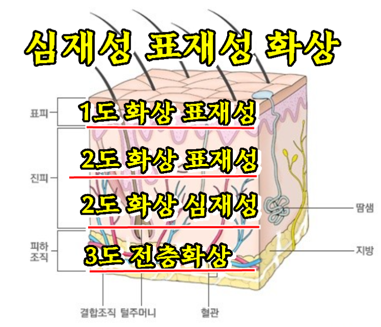  표재성 2도화상, 심재성 3도 화상 피부이식
