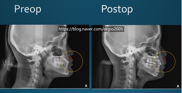 양악수술&gt; 양악수술에 따른 인중의 길이 변화 (feat. 인중이 정말 길어져?)