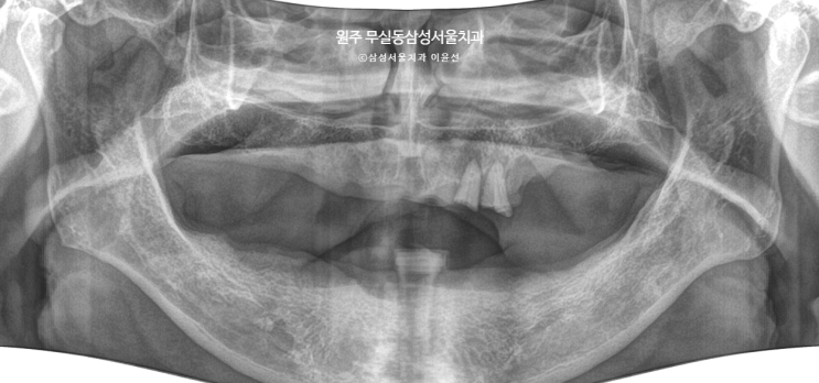  이가 하나도 없어요~ 씹을수 있게 해주세요 , 원주 무실동 삼성서울치과에서 임플란트, 틀니하기