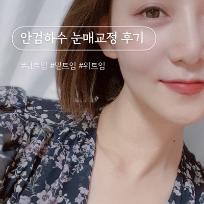 안검하수수술비용 쌍수절개 6개월후 눈매교정 후기 안검하수 실비 여부 쌍수 흉살