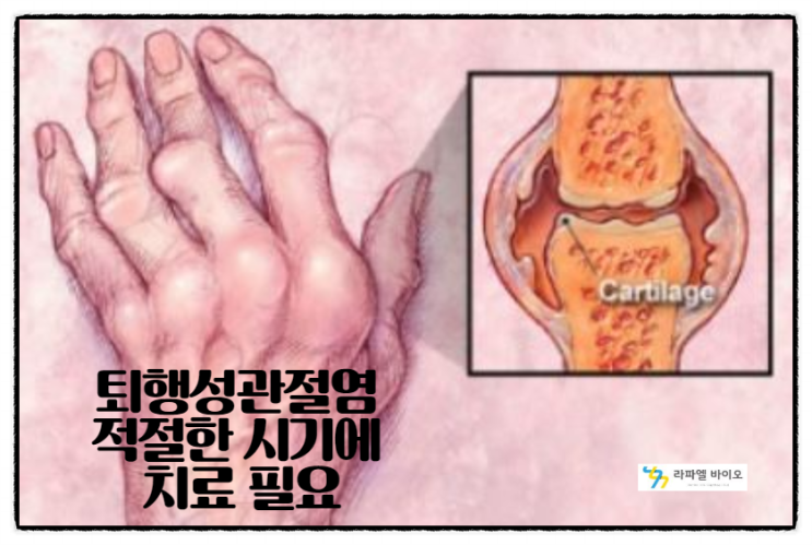  퇴행성관절염(골관절염) 적절한 시기에 치료필요