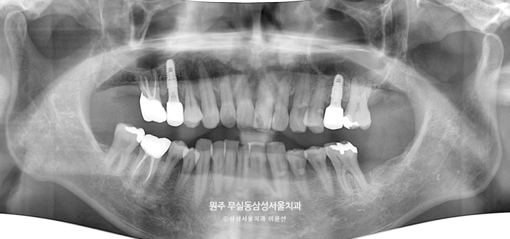  간단한 임플란트, 원주 무실동 삼성서울치과에서 간단하게 임플란트하기