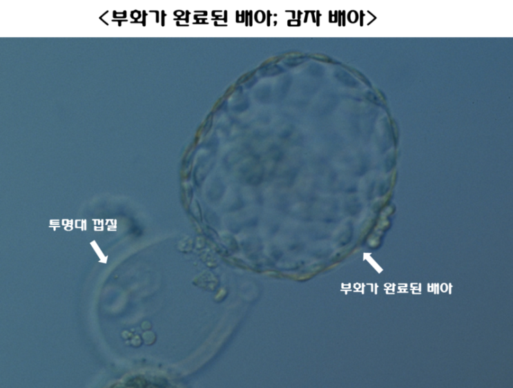 [시험관1차]과정의 끝. 이식 완료