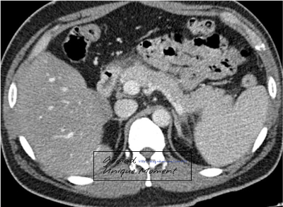  [복부 CT] - 췌장(Pancreas) ; 급성췌장염/만성췌장염