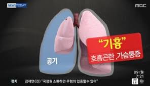  기흉 호흡기질환케이스 치료방법 3편 : 기흉치료방법 수술방법 예후