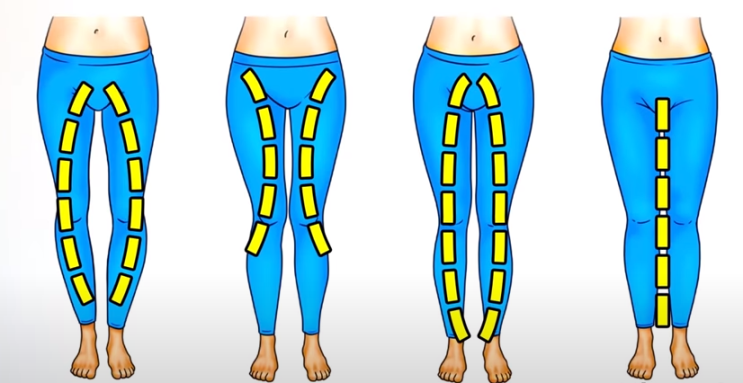  다리교정운동 O, X, XO, 정상까지 예쁜다리만드는 간단동작